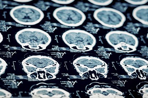 Serious Facts About Traumatic Brain Injury