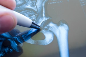 DePuy Settles Over Faulty Surgical Hip Implants